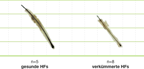 Gesunde Haarwurzeln und verkümmerte Haarwurzeln werden sichtbar unter dem Mikroskop